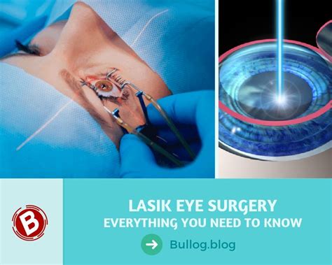 lasik eye surgery video